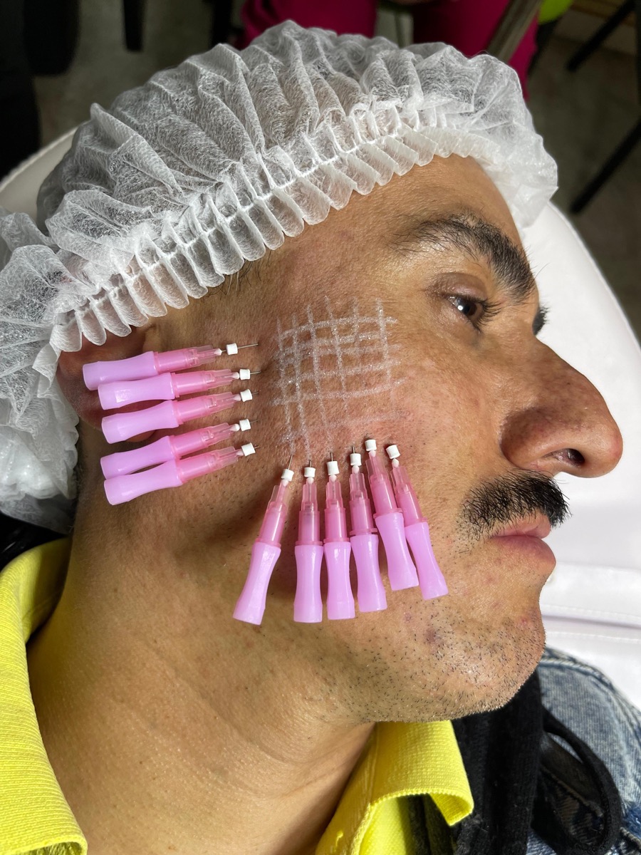 Colocación de hilos lisos en el rostro