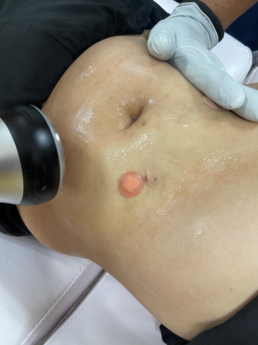 Sesión de modelado corporal en abdomen